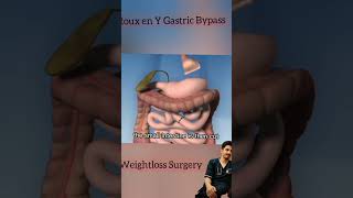 Roux En Y Gastric Bypass Animation  Weightloss Surgery  Bariatric Surgery health medicine [upl. by Yromem]