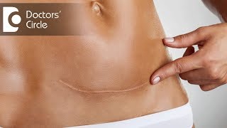 How to manage incision pain right after 1 month of Cesarean Section  Dr Shailaja N [upl. by Hnao969]