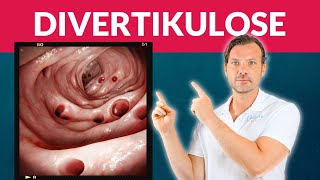 Divertikulose vermeiden Entzündung Divertikulitis muss nicht sein [upl. by Ayal804]