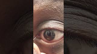 Stringy Mucus Eye Fishing Syndrome Eye Gunk Removal [upl. by Genet130]