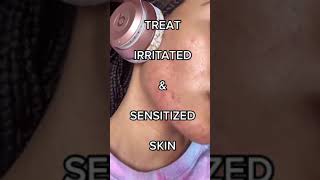 HOW TO TREAT IRRITATED AND SENSITIZED SKIN fast and easy‼️😅 [upl. by Atilamrac828]