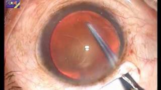 SMALL INCISION CATARACT SURGERY [upl. by Laekim657]