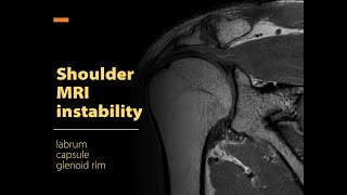 Shoulder MRI instability Labrum capsule glenoid rim [upl. by Cairistiona946]