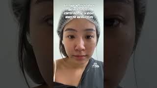 My nonincisional double eyelid procedure 2022 ft Allure Plastic Surgery ￼ [upl. by Hgielsa940]