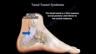 Tarsal Tunnel Syndrome causes and treatment [upl. by Ydnamron]