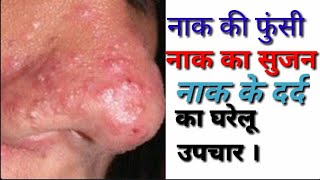 नाक में फुंसी  नाक का दर्द  और नाक के सभी समस्याओं का घरेलु उपचार । all nose problem treatment [upl. by Xineohp]