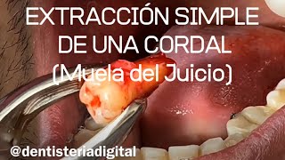 EXTRACCIÓN SIMPLE DE UNA CORDAL Muela del Juicio [upl. by Pirali]