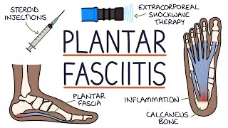 Understanding Plantar Fasciitis [upl. by Aem]