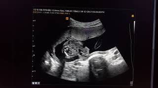 Gastroschisis Sonography [upl. by Ranie]