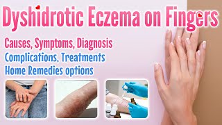 Dyshidrotic eczema on fingers overview causes symptoms treatment options and home remedies [upl. by Jenny]