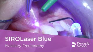 SIROLaser Blue  Maxillary Frenectomy [upl. by Mandel]