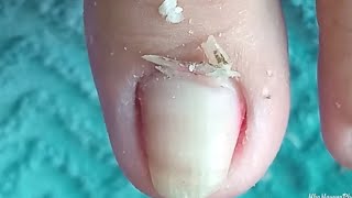 Clean the corners of your toenails at home without needing  part 65 NhaNguyenPhanThiet [upl. by Josselyn425]