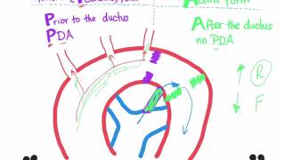 Coarctation of aorta [upl. by Cosmo]