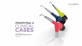 Case Studies for the KaVo PROPHYflex 4 air polishing device  UK [upl. by Ecnar]