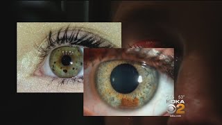 New Study Looks At Possible Relationship Between Eye Freckles And Melanoma [upl. by Ul]