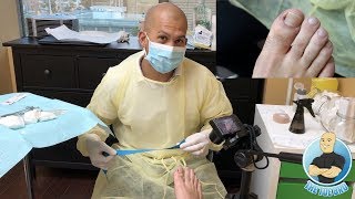 INGROWN TOENAIL SURGERY  How To Remove An Ingrown Toenail Forever POV [upl. by Rolan857]