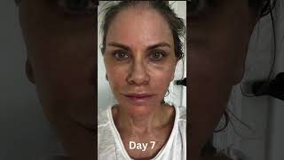 62 Year Old Undergoes Life Changing Facelift Fat Transfer and Lip Lift [upl. by Lucas]