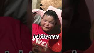 Ichthyosis skincare Ichthyosis eczema [upl. by Guglielma872]