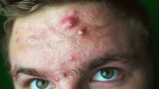 EVERY ACNE SUFFERER NEEDS TO SEE THIS  How To Get Past the Insecurity [upl. by Elletnahs]