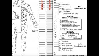 Classifying Spinal Cord Injuries using ASIA Scoring Explanation  Example 1 [upl. by Solegnave]