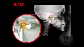 ATM Odontologia® Articulación Temporomandibular [upl. by Braeunig289]