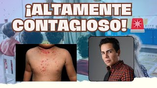 MOLUSCO CONTAGIOSO EN MENORES I JAVIER DERMA [upl. by Valer]