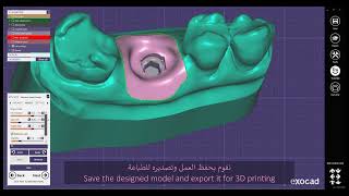 How to Design a Gingival Mask for an Implant Digital Model in exocad [upl. by Ennovoj]