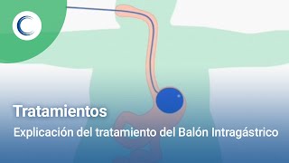 Explicación del Balón Intragástrico [upl. by Nee]