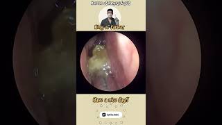 귀지형 콧물 부비동염 축농증 비염 코청소 이비인후과 rhinorrhea rhinitis sinusitis asmr ENT ENTdoctor [upl. by Salas]