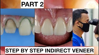 Step by Step 2 Indirect Veneer with Discoloration Tooth Part 2  General Dentist Griya RR [upl. by Fischer331]