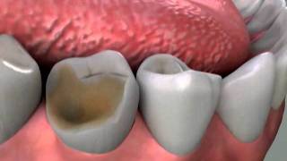 Crowns Core Build Up Procedure [upl. by Phene]