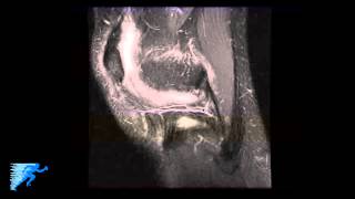 How to Read Knee MRI of MCL Injury  Complex Knee Surgeon  Knee Pain Diagnosis  Twin Cities MN [upl. by Lednahs]