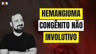 Hemangioma congênito não involutivo  José Góes [upl. by Alonso]