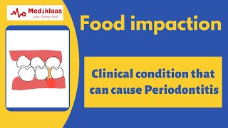 Food impaction  A cause for periodontitis  Caries  gum problem Mediklaas [upl. by Aldridge]