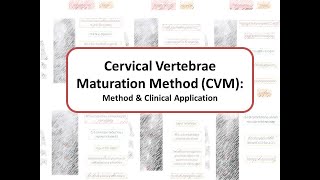 Cervical Vertebral Maturation method CVM Method amp Clinical application [upl. by Jenn]