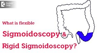 Rigid vs Flexible Sigmoidoscopy  Dr Rajasekhar M R [upl. by Harms]