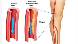 Claudication in legs  treatment  exercise  claudication Pathophysiology [upl. by Blumenfeld847]