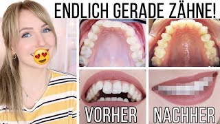 VORHERNACHHER SO sehen meine Zähne JETZT aus Meine Erfahrung mit Invisalign TheBeauty2go [upl. by Nilrac]