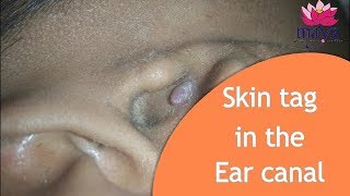 Skin tag in the Ear canal removed with laser  Dr Anand Jaiswals MayaSkinclinic M5 [upl. by Llehsim]