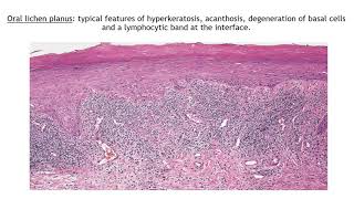 Lecture43 Lichen Planus and Lichenoid disorders Rooks chapter 37 [upl. by Nahgen]