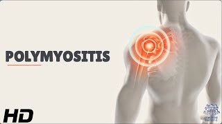 Polymyositis Understanding the Rare Autoimmune Disease [upl. by Eihtur]