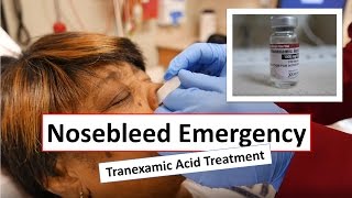 Nosebleed Emergency and Tranexamic Acid Treatment [upl. by Xonk]