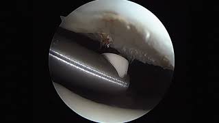 Arthroscopic Chondral Debridement Using Radiofrequency [upl. by Salim]