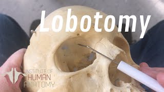 The Anatomy of a Lobotomy [upl. by Chapin293]