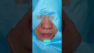 ALARPLASTY ON SMALL NOSE  DR TANVEER JANJUA NEW JERSEY [upl. by Rexanna]