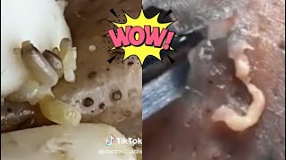 Ultimate Pimple Popping Compilation  Extreme Acne Treatment  Satisfying Blackhead Removal [upl. by Notirb]