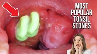 Tonsil Stones amp Removal At Home Compilation  Most Popular [upl. by Iaj]