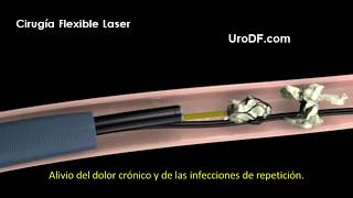 Cirugía Flexible Laser [upl. by Spalding]