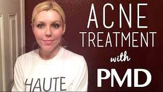 PMD Personal Microderm Review for Acne amp Acne Scars Treatment [upl. by Nomde]