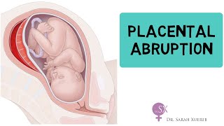 Placental Abruption [upl. by Anneis]